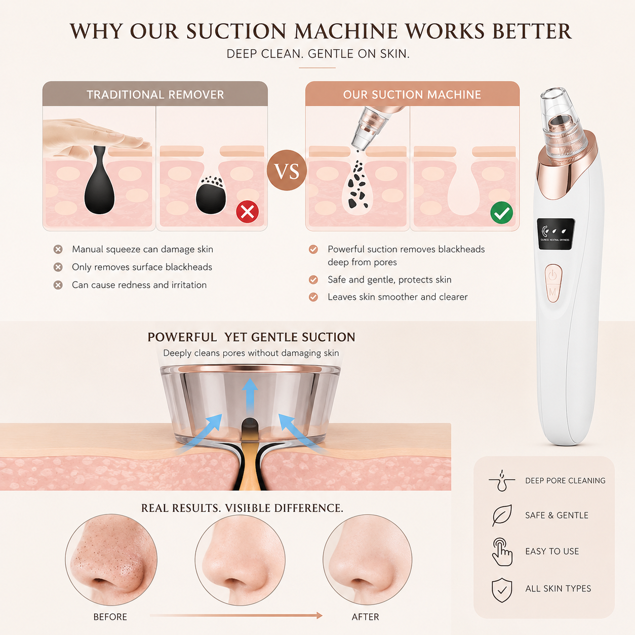 Professional Blackhead and Pore Vacuum